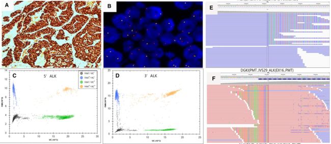 dPCR用于肺癌ALK基因检测研究，J. Cancer Res. Clin. Onc., 2020